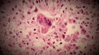Peel Public Health investigating measles exposure on June 13