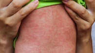 Ontario reports 12 new measles cases, continuing downward trend