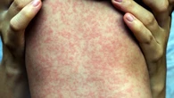 Spike in Winkler-area measles exposures due to low vaccination rates in region, health official says
