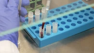 Canadians researching technology that uses bloodwork to find tiny cancer cells