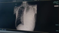 Nunavik tuberculosis action plan to be finalized in coming weeks, says health ministry