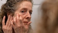 Dermatology wait times skyrocket in Canada — unless you want Botox
