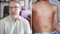 Measles spread 'like wildfire' among unvaccinated children in northeast B.C., health officer says
