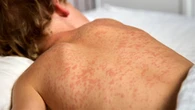 Measles jumps by 65 cases in Elgin and Oxford Counties, totalling above 1,200 across Ontario