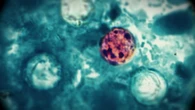Explosive diarrhea-causing parasite infects more than 1,000 people in U.S.