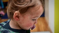 Measles concerns growing for Manitoba parents as official says province is seeing outbreak