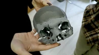 Una fundación financia en Ucrania la reconstrucción facial de heridos