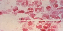 In Inghilterra ci sono moltissimi casi di gonorreaPer questo il Servizio sanitario pubblico avvierà la prima campagna vaccinale al mondo contro questa malattia sessualmente trasmissibile