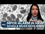 NRW: Mpox-Alarm! Neue Variante in Deutschland aufgetaucht! Schule in Rösrath bei Köln muss schließen