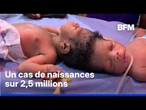 Deux jumelles siamoises, reliées par le crâne, séparées grâce à l'utilisation de l'IA