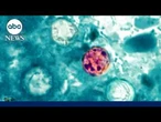 Health alert about cyclosporiasis parasitic infection