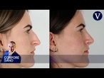 Errores comunes después de una rinoplastia y cómo evitarlos | Corpore Sano