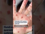 Hundreds of U.S. students quarantined amid measles outbreaks
