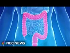 New blood test is added an an option for colorectal cancer screenings