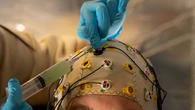 Przełom w medycynie. Implant pozwolił pacjentce „mówić” myślami