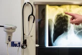 Entwarnung nach Tuberkulose-Ausbruch in Dresdner Kita?