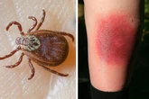Zeckenjahr 2025: Schon rund 2000 Borreliose-Fälle in Sachsen