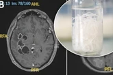 Ärzte suchen nach Krebs, doch im Gehirn des Patienten machen sie eine unerwartete Entdeckung