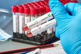 HIV und andere sexuell übertragbare Infektionen in Hessen: So ist der aktuelle Stand