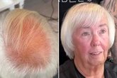 Frau ist wegen Haarausfall todunglücklich: Wie sie nach Umstyling aussieht, sorgt für Staunen