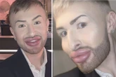 Mann ist süchtig nach Beauty-Eingriffen, dann trifft er drastische Entscheidung