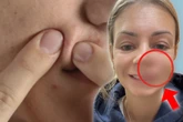 Frau will Pickel ausdrücken: Was dann passiert, hat sie nicht erwartet