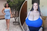 Schockdiagnose Gigantomastie: Junger Frau wächst plötzlich Riesen-Busen