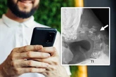 Mann starrt ständig auf sein Handy: Dann entwickelt er eine gefährliche Krankheit
