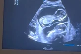 Als Schwangere dank Ultraschall sieht, was ihre Babys gerade tun, ist sie sprachlos