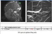 Đau đầu 4 ngày, đến viện mới phát hiện mắc thể đột quỵ não đặc biệt