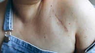 Why scars never disappear