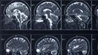 A brain implant to treat depression gets FDA greenlight to start trials