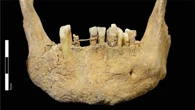 A medieval Scot rocked a 20-carat gold dental bridge
