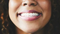 No, white teeth don’t mean healthy teeth