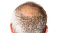 3 hair loss myths you probably believe