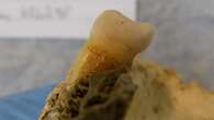 Rare traces of tooth decay and gum disease found in Bronze Age teeth