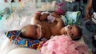 Baby shower held for formerly conjoined twins