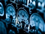 Cancer cases worldwide are expected to soar in the coming decades, a report finds. Here’s why.