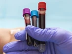 Blood tests promise to detect cancer early. How well do they work?