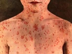 Canada’s status as a country without endemic measles can now be revoked