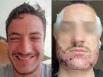 French man dies by suicide after failed beard transplant by 'estate agent': 'He entered a vicious cycle'