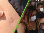 Por qué una vacuna dejó una marca en el brazo de todos los mexicanos