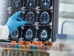 AVC, Alzheimer… L’inquiétante progression des pathologies neurologiques