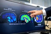 Médicaments anti-Alzheimer, le débat est nécessaire : l’appel d’un collectif de scientifiques