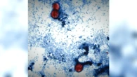 86 people have been hospitalized with foodborne parasite spreading across the U.S., CDC says