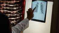 World Health Organization warns of possible tuberculosis surge because of USAID cuts