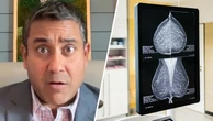 When should you get a mammogram? Conflicting advice makes it hard to know
