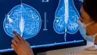 Why some doctors see a downside to notifying women about dense breasts