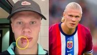 Haaland needs three stitches as Man City star hit in face by Norway team BUS