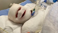 Horror photos reveal true dangers of ibuprofen after mum's skin 'fell off'